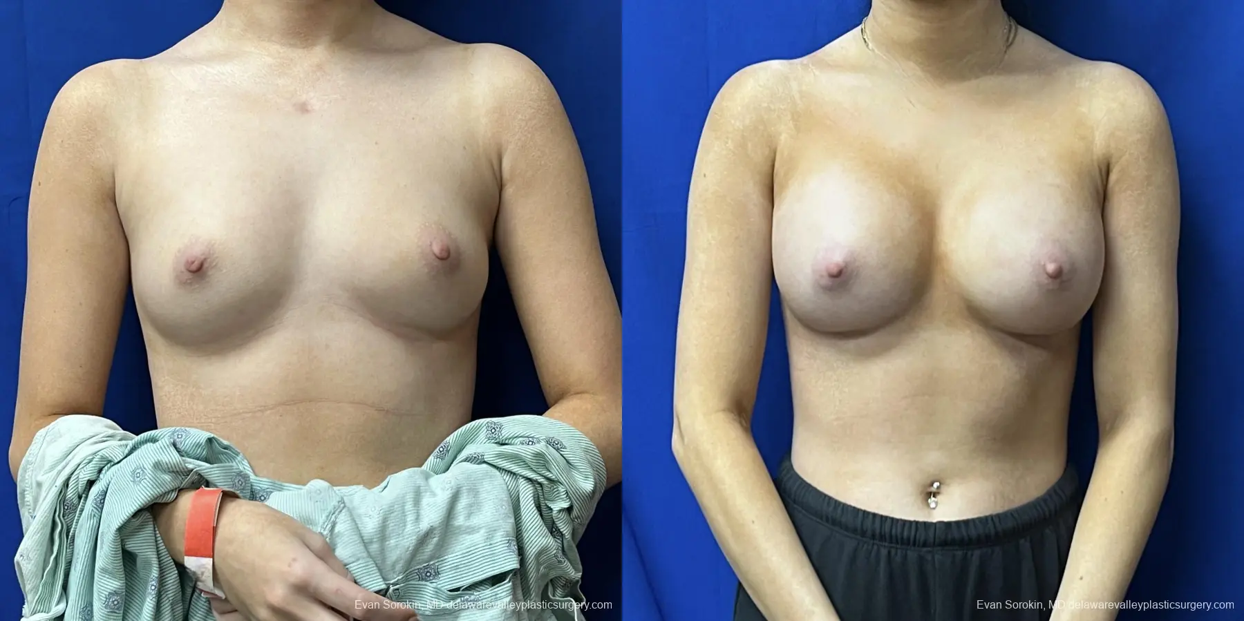 Breast Augmentation: Patient 247 - Before and After 1