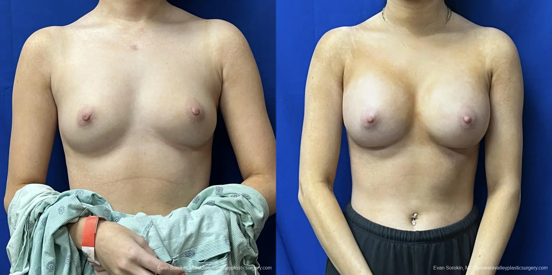 Breast Augmentation: Patient 215 - Before and After 1