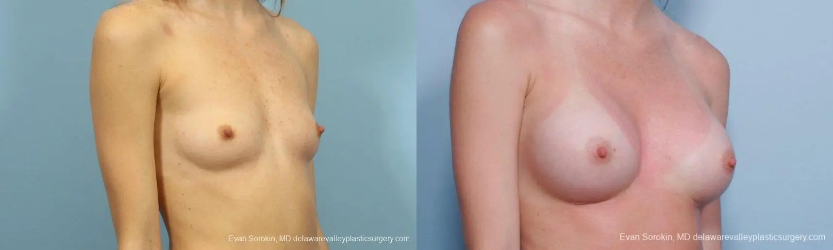 Philadelphia Breast Augmentation 8660 - Before and After 2