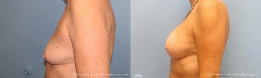 Philadelphia Breast Augmentation 9600 - Before and After 5