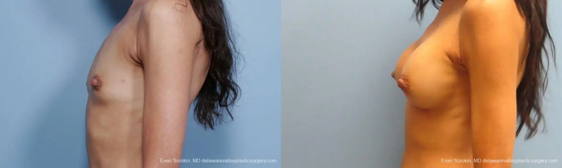 Philadelphia Breast Augmentation 9424 - Before and After 5