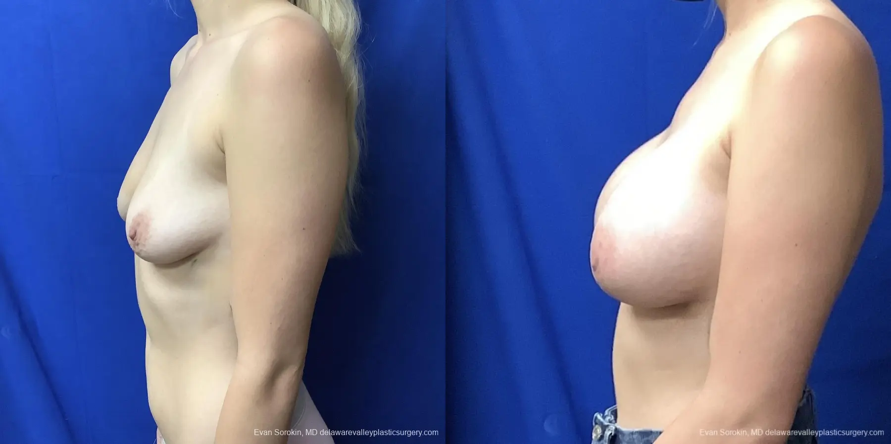 Breast Augmentation: Patient 211 - Before and After 5