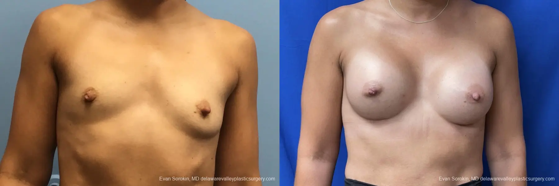 Breast Augmentation: Patient 208 - Before and After 1