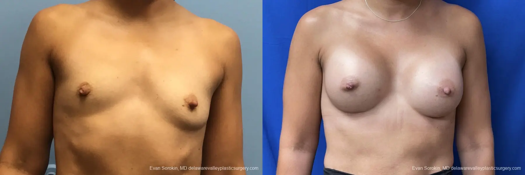 Breast Augmentation: Patient 180 - Before and After 1