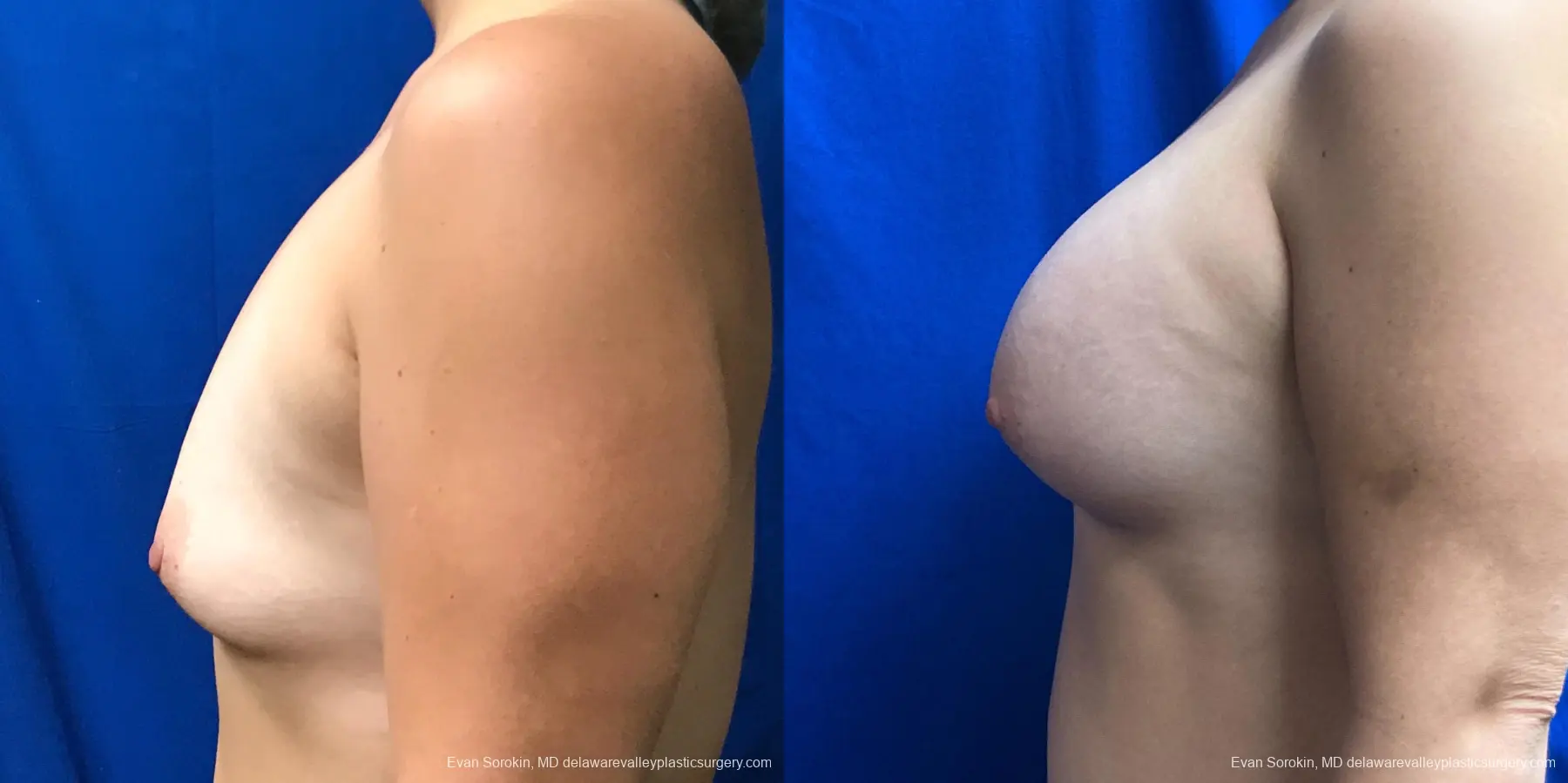 Breast Augmentation: Patient 219 - Before and After 5