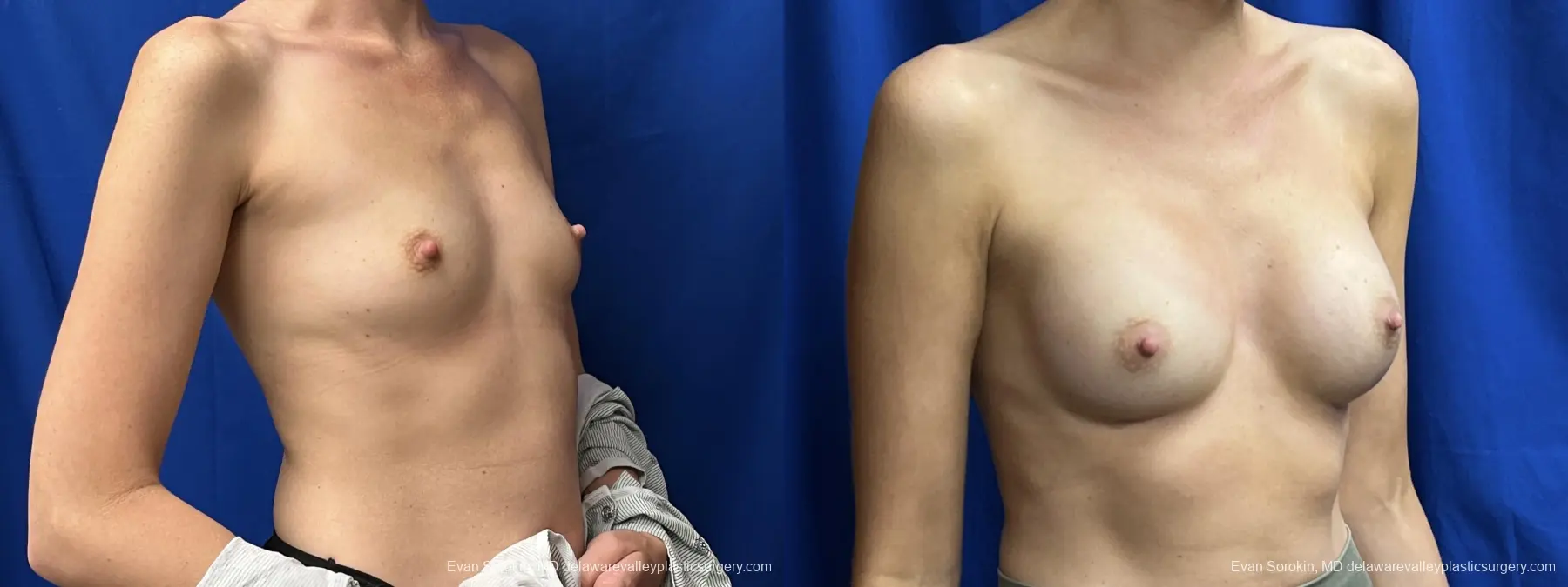 Breast Augmentation: Patient 211 - Before and After 2