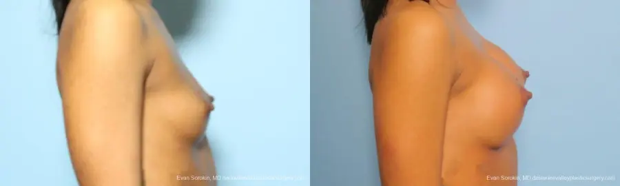 Philadelphia Breast Augmentation 9182 - Before and After 3