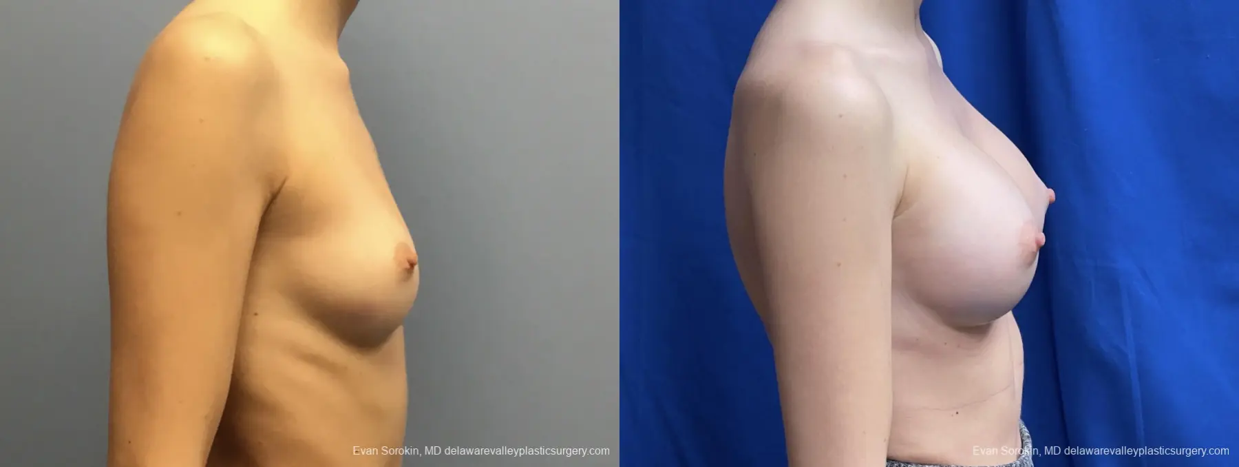 Breast Augmentation: Patient 201 - Before and After 3