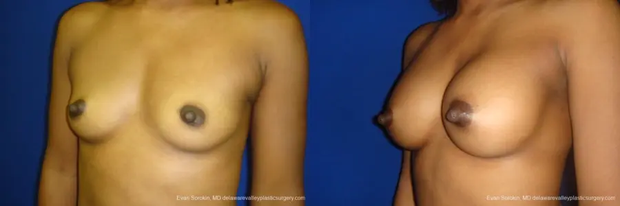 Philadelphia Breast Augmentation 8665 - Before and After 3