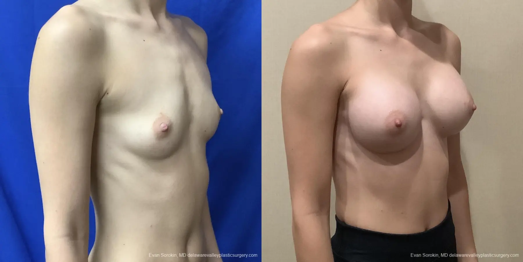 Breast Augmentation: Patient 181 - Before and After 2