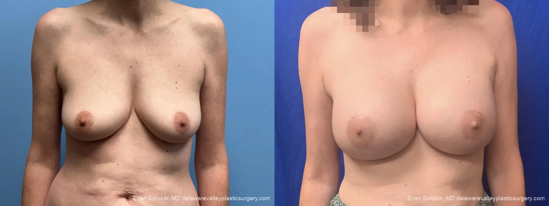 Breast Augmentation: Patient 328 - Before and After 1