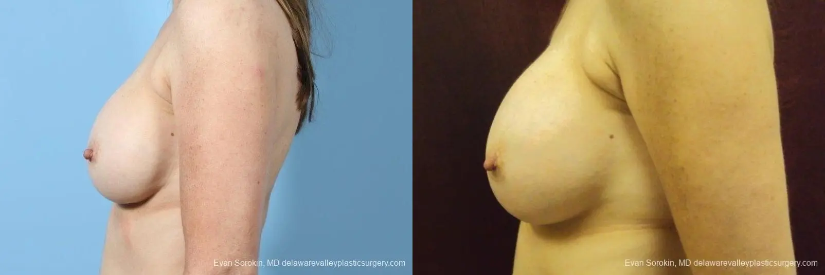 Philadelphia Breast Augmentation 8708 - Before and After 4