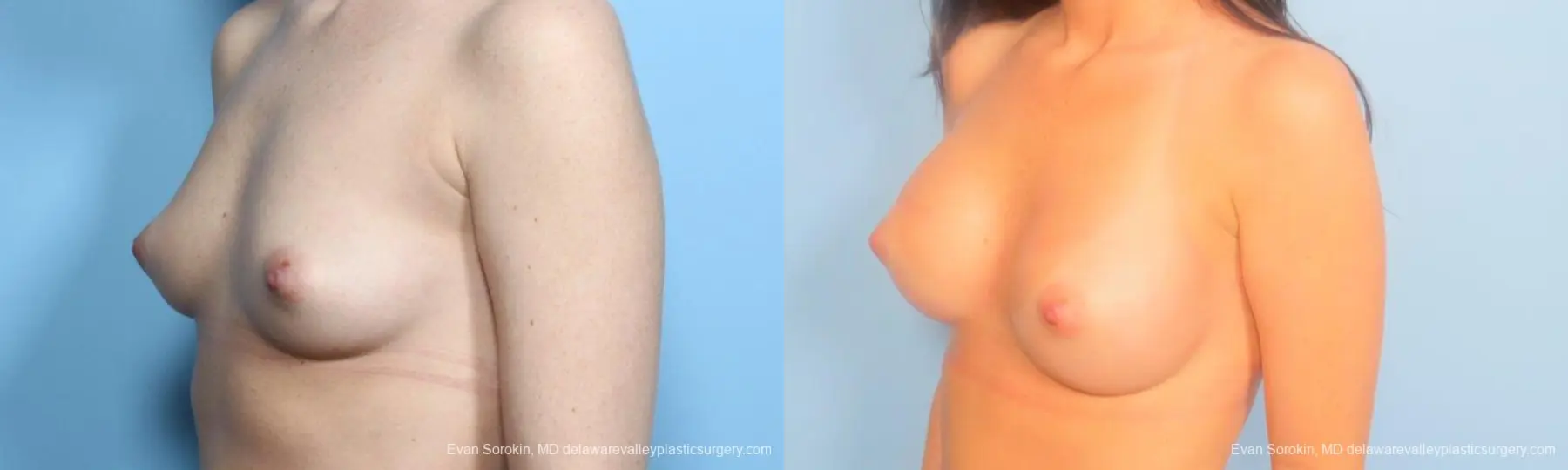 Philadelphia Breast Augmentation 9181 - Before and After 4