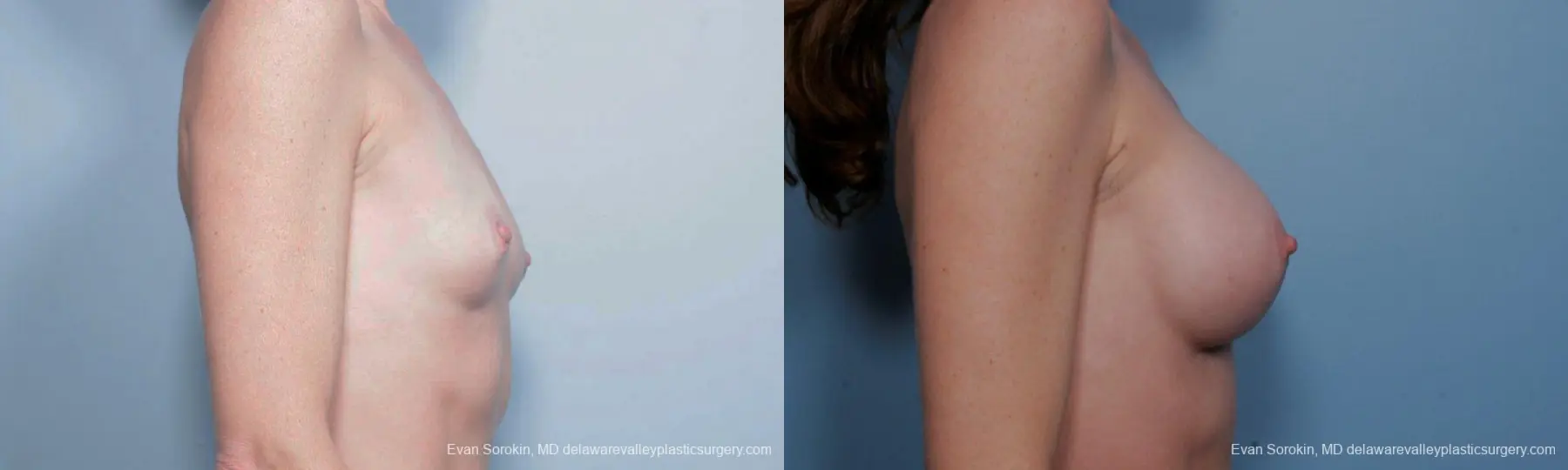 Philadelphia Breast Augmentation 9459 - Before and After 3