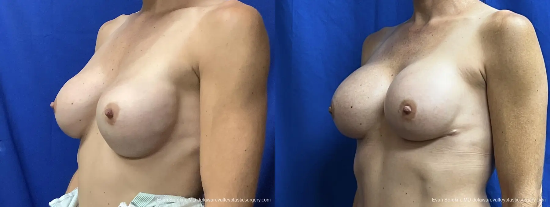 Breast Augmentation Revision: Patient 34 - Before and After 4