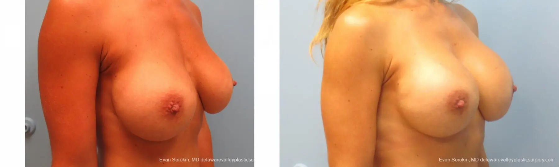 Breast Augmentation Revision: Patient 10 - Before and After 4