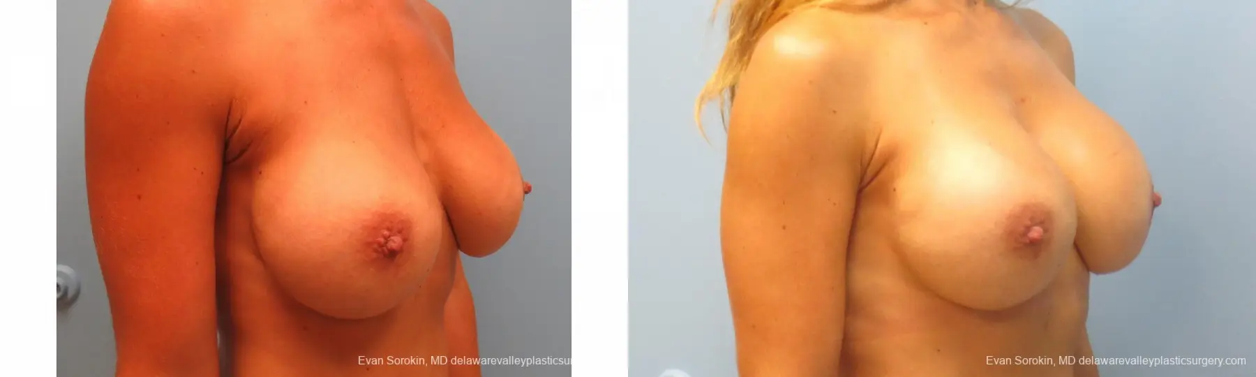 Breast Augmentation: Patient 113 - Before and After 4