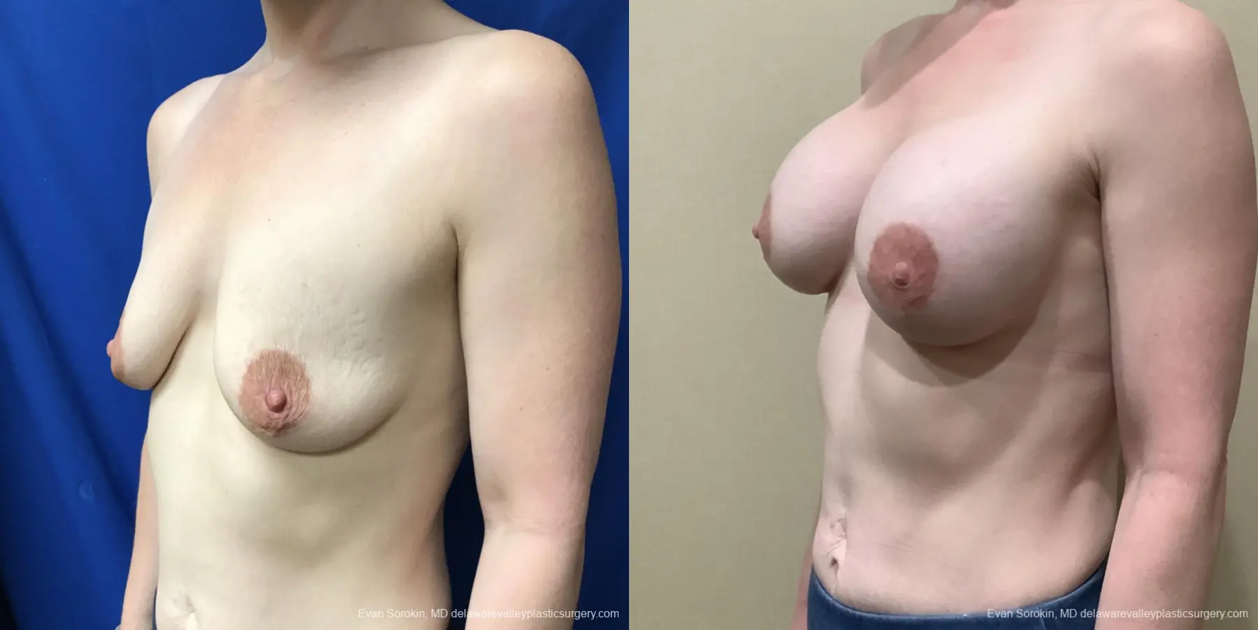 Breast Augmentation: Patient 188 - Before and After 4