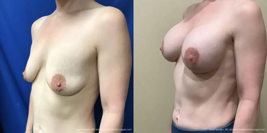 Breast Augmentation: Patient 188 - Before and After 4