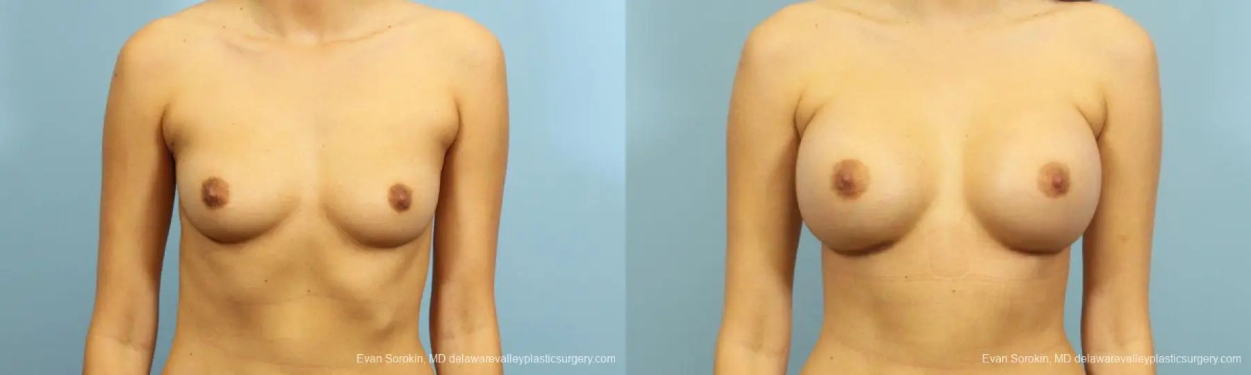 Philadelphia Breast Augmentation 9195 - Before and After 1