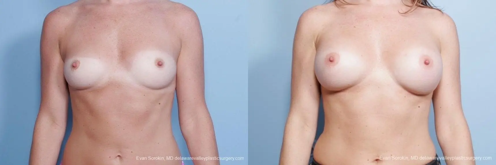 Philadelphia Breast Augmentation 8785 - Before and After 1