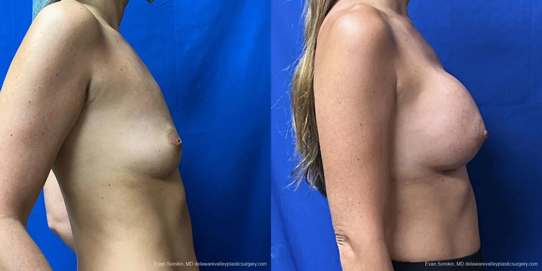 Breast Augmentation: Patient 198 - Before and After 3