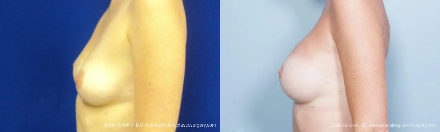 Philadelphia Breast Augmentation 8777 - Before and After 5