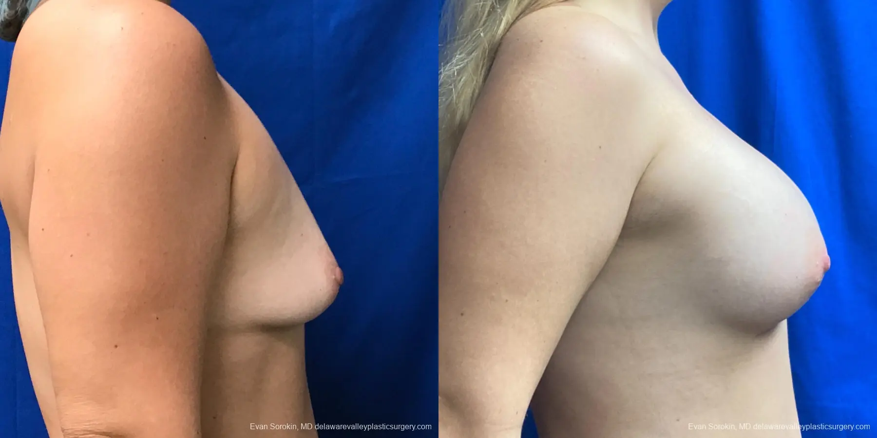 Breast Augmentation: Patient 190 - Before and After 3
