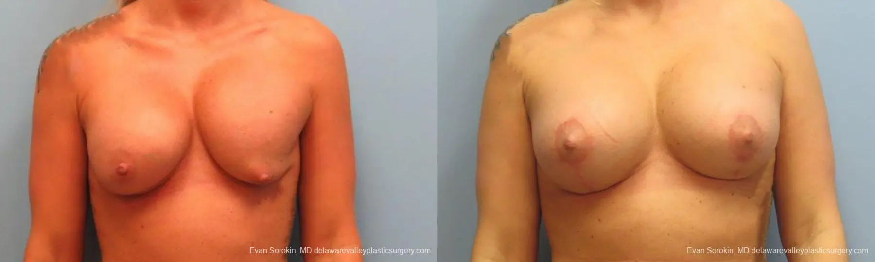 Philadelphia Breast Augmentation 9369 - Before and After 1