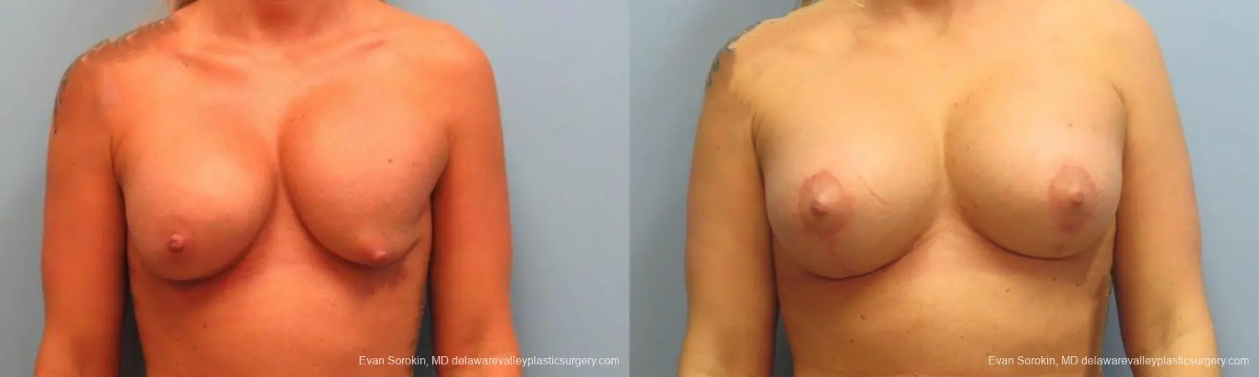 Philadelphia Breast Augmentation 9369 - Before and After