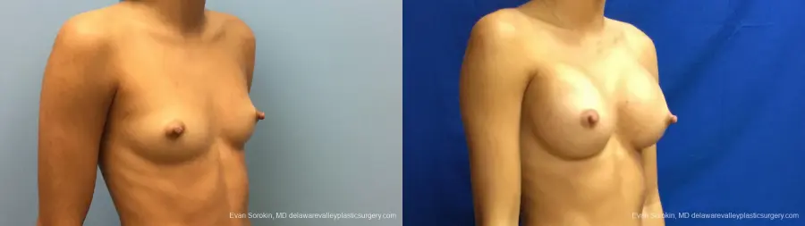 Philadelphia Breast Augmentation 13176 - Before and After 2