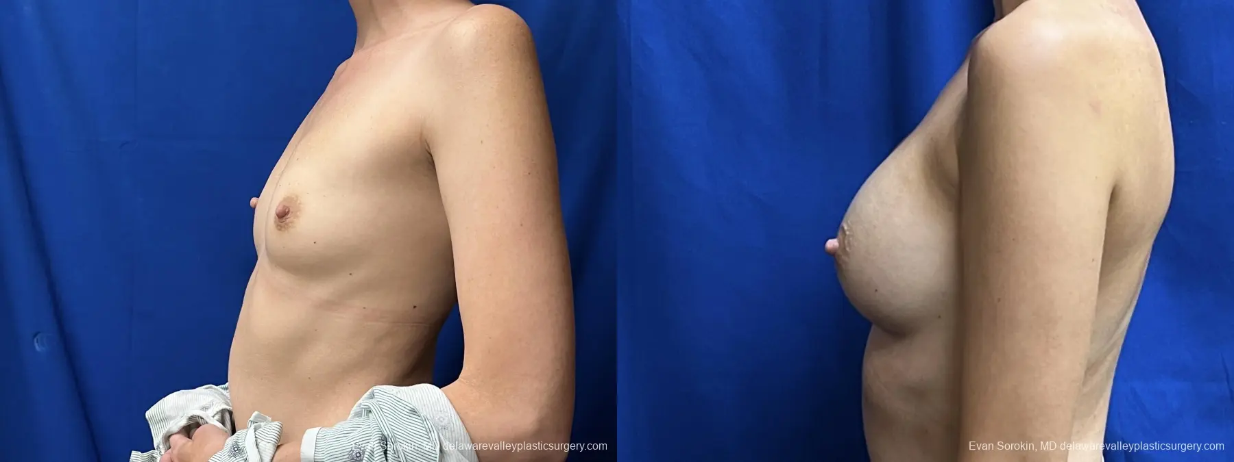 Breast Augmentation: Patient 211 - Before and After 5