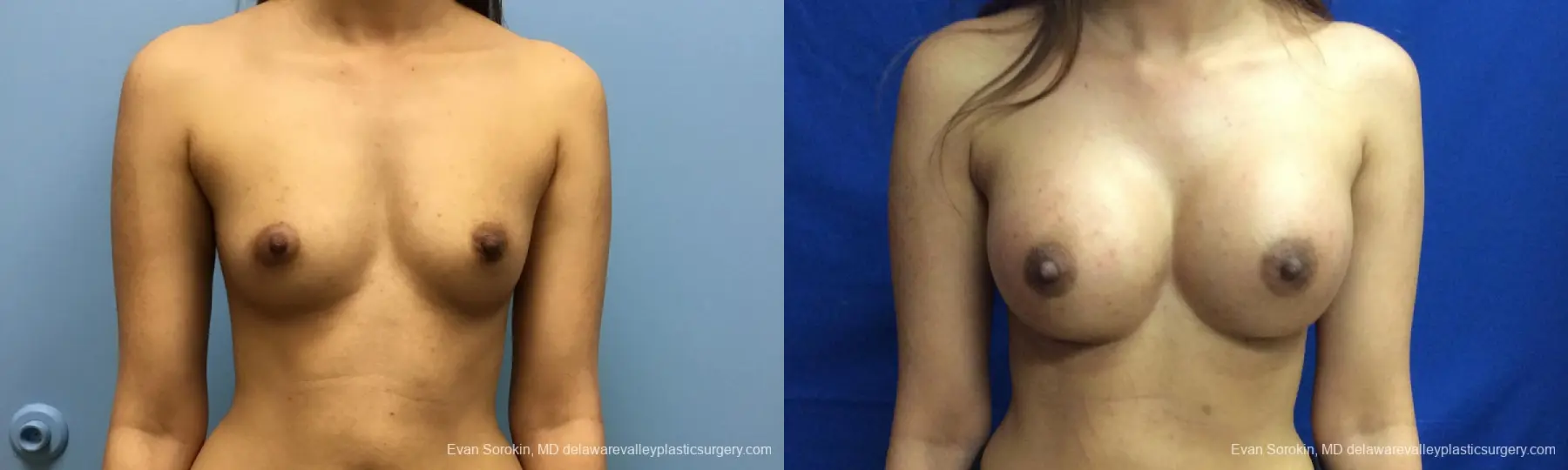 Philadelphia Breast Augmentation 12515 - Before and After 1