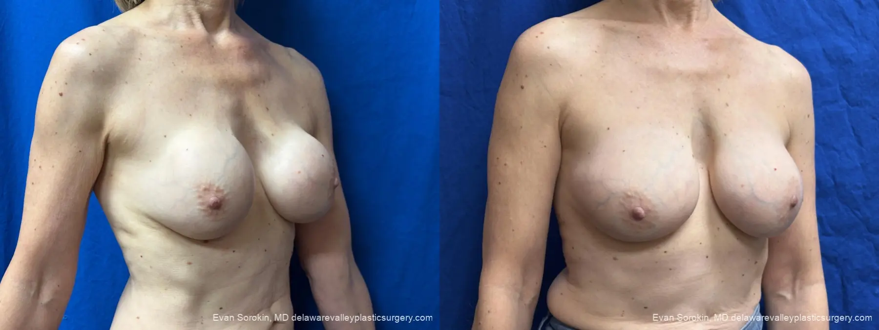 Breast Augmentation Revision: Patient 51 - Before and After 2