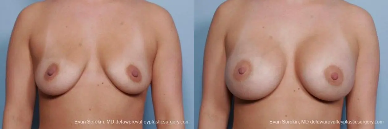 Philadelphia Breast Augmentation 9414 - Before and After 1