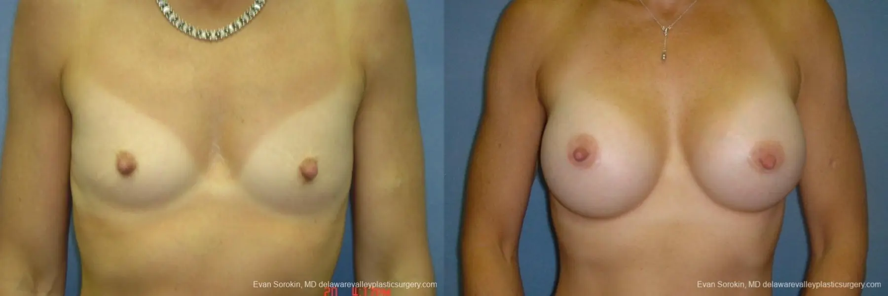 Breast Augmentation 8667 - Before and After 1