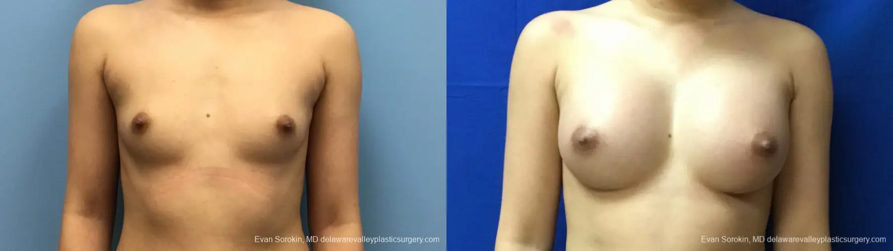 Philadelphia Breast Augmentation 13172 - Before and After 1