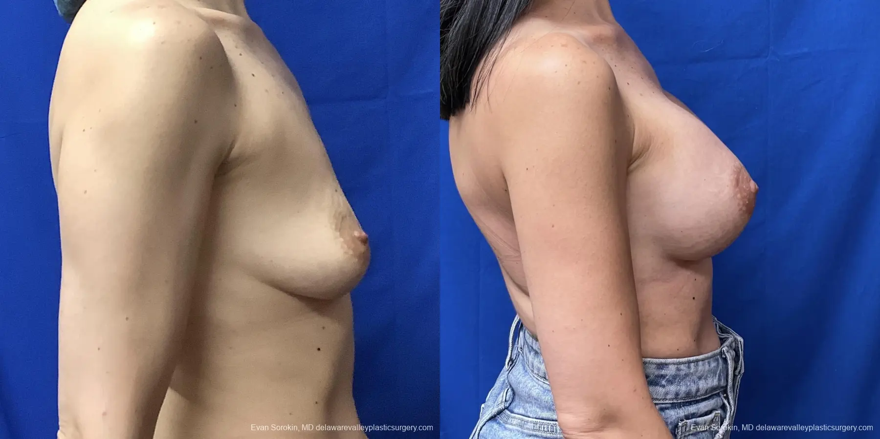 Breast Augmentation: Patient 173 - Before and After 3