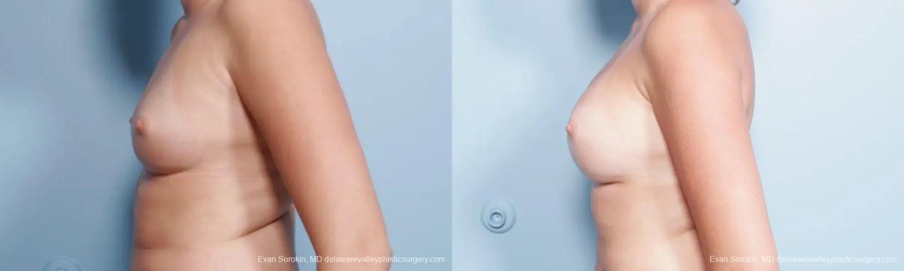 Philadelphia Breast Augmentation 9301 - Before and After 5