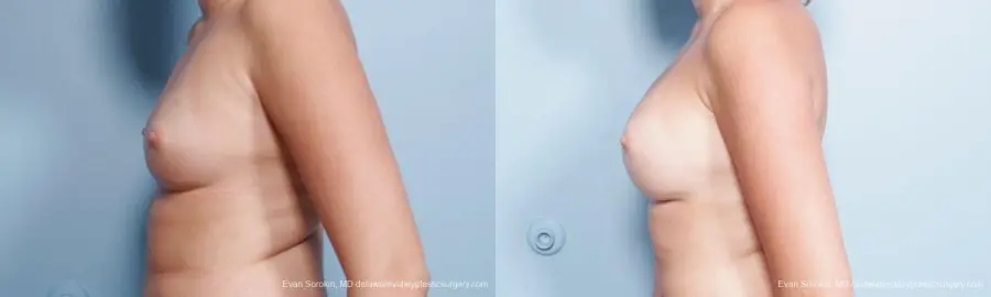 Philadelphia Breast Augmentation 9301 - Before and After 5