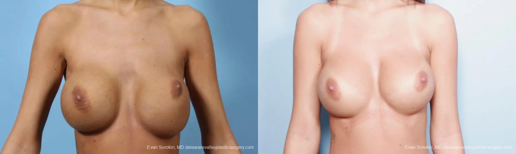 Philadelphia Breast Augmentation 9445 - Before and After 1