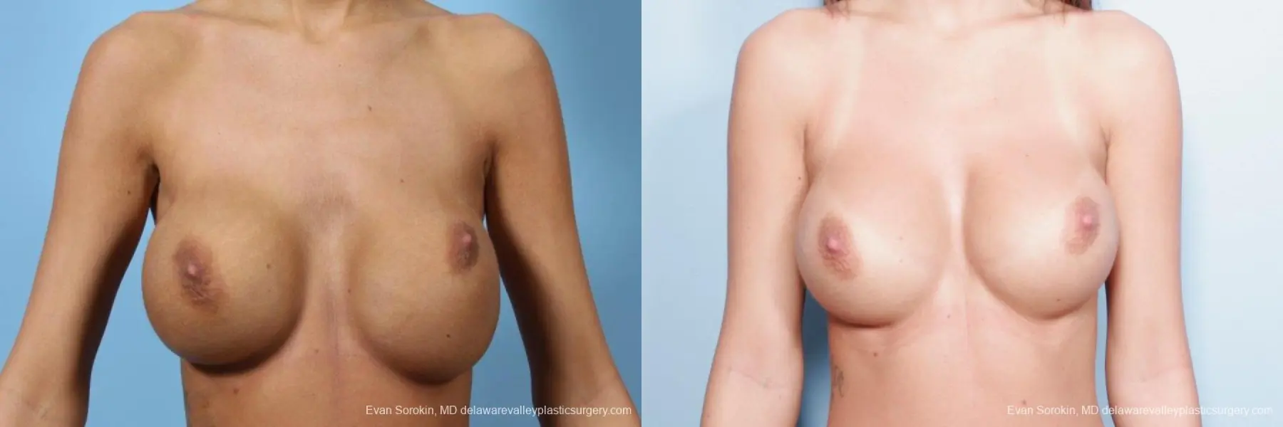 Philadelphia Breast Augmentation 9445 - Before and After