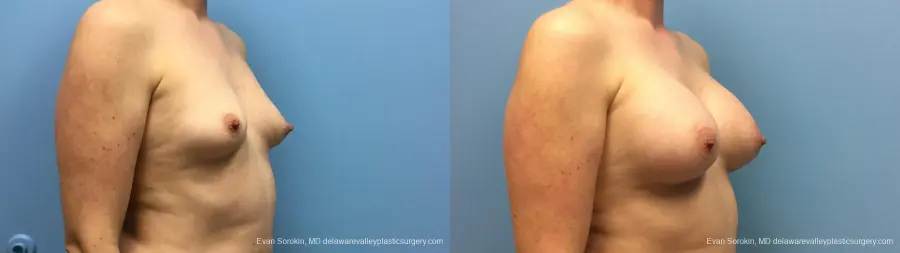Philadelphia Breast Augmentation 13181 - Before and After 2