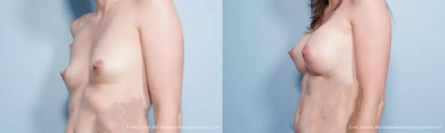 Philadelphia Breast Augmentation 9175 - Before and After 4