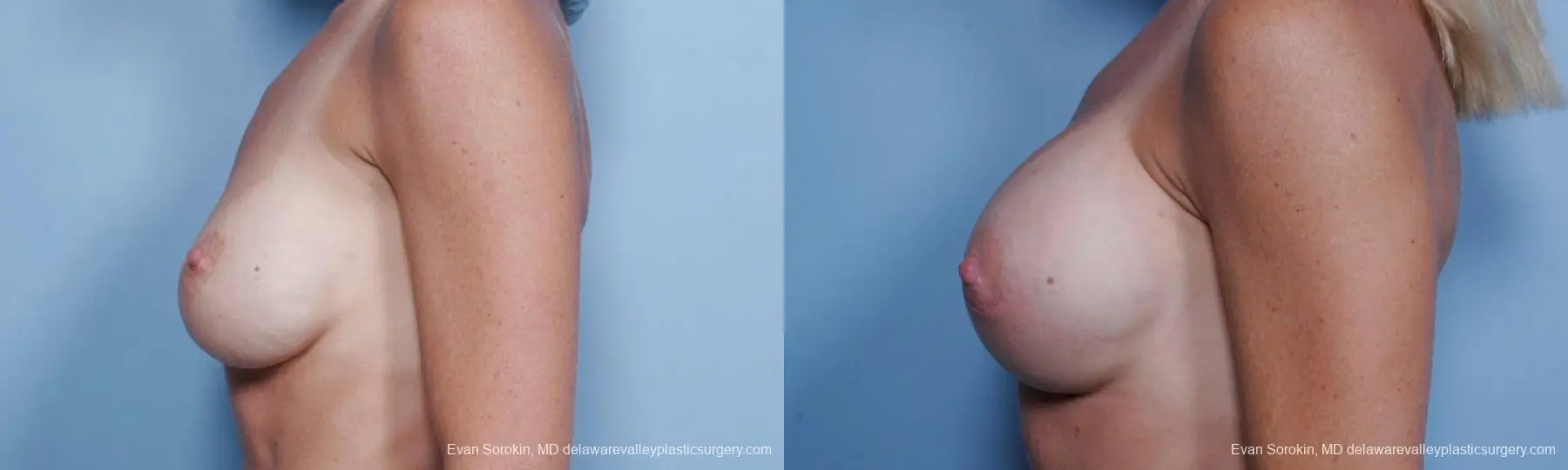 Philadelphia Breast Augmentation 9454 - Before and After 5