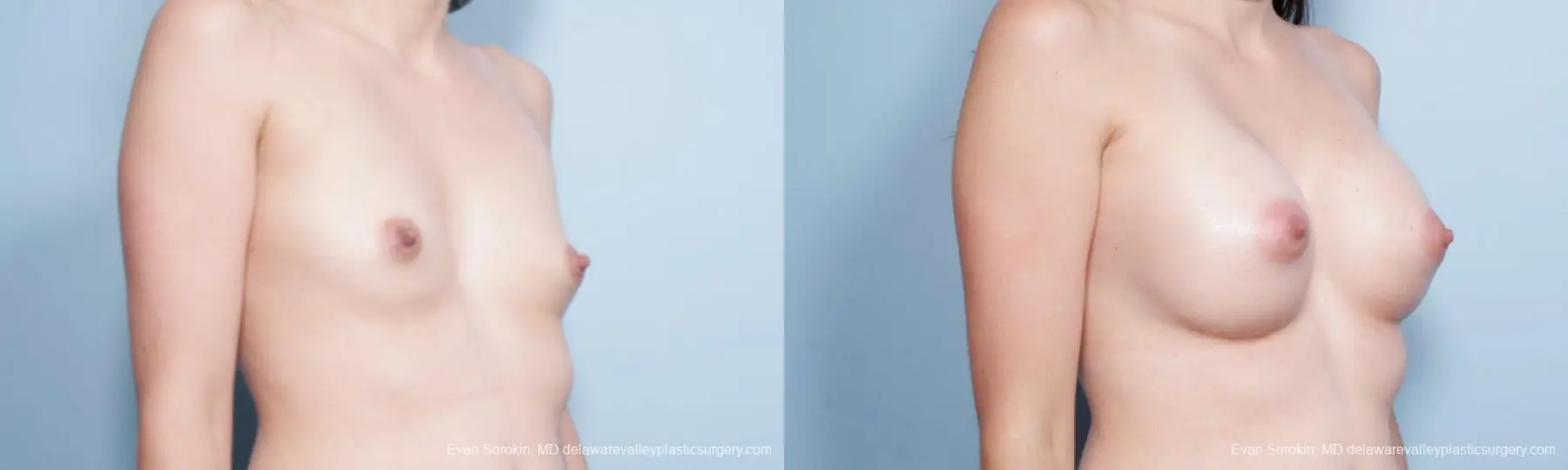 Philadelphia Breast Augmentation 9175 - Before and After 2