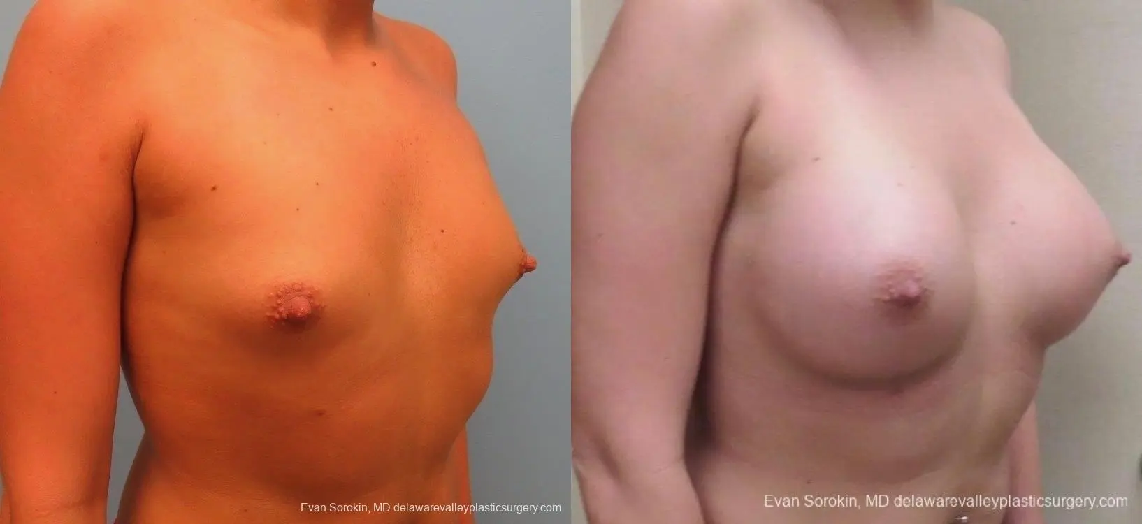 Philadelphia Breast Augmentation 8826 - Before and After 2