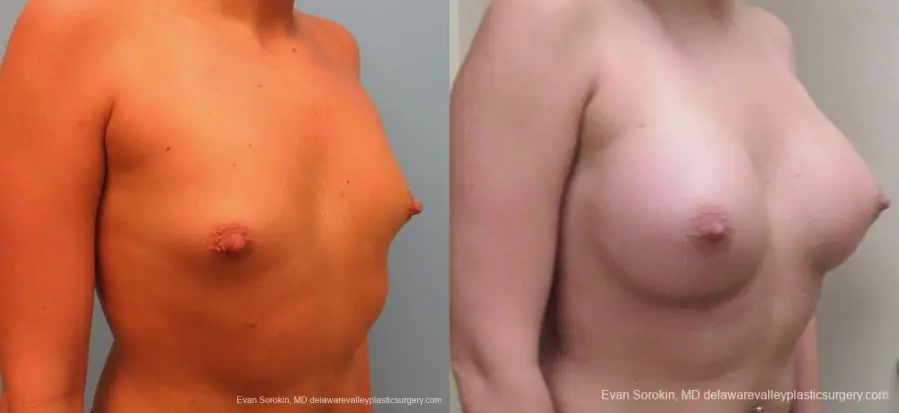 Philadelphia Breast Augmentation 8826 - Before and After 2