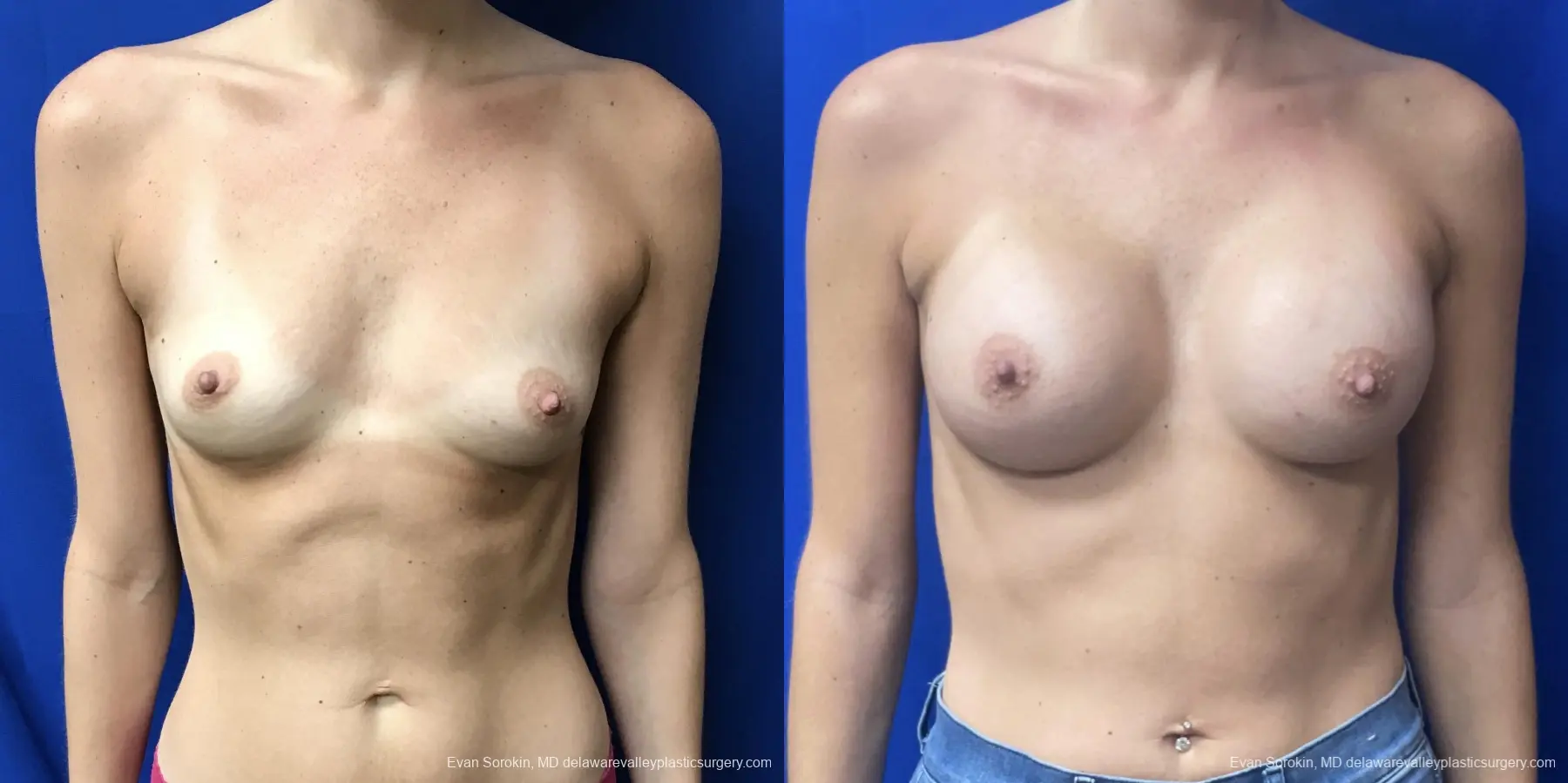 Breast Augmentation: Patient 213 - Before and After 1