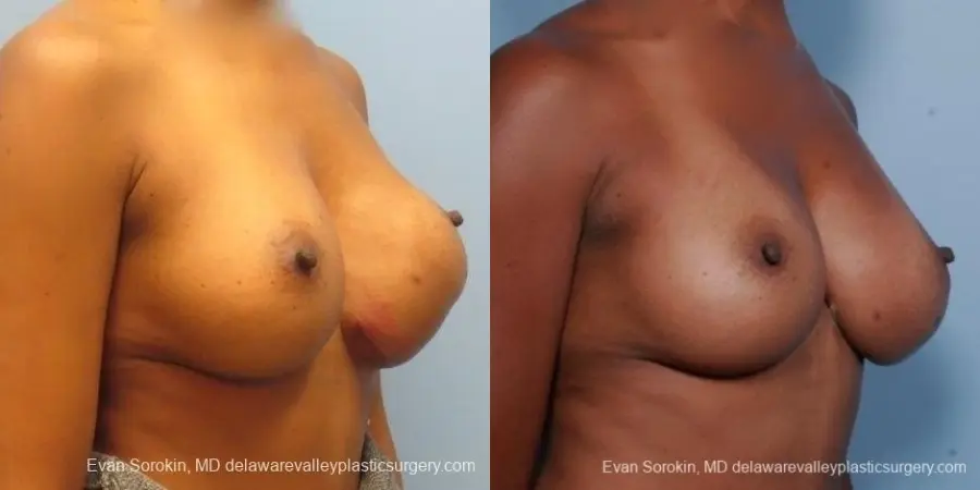 Philadelphia Breast Augmentation 8653 - Before and After 2
